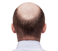علاج تساقط الشعر على الطريقة الصينية
