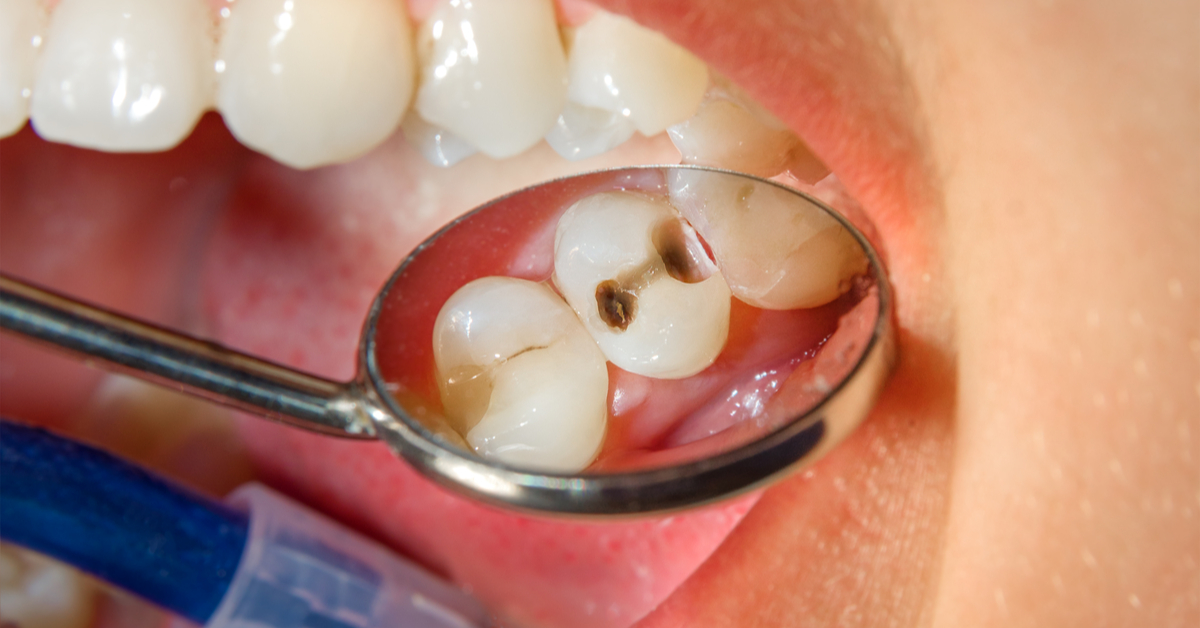 أنواع تسوس الأسنان بالصور طب الويب