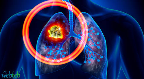 Pembrolizumab ناجع في علاج النقيليات الدماغية لسرطان الرئة من نوع NSCLC Pembrolizumab ناجع في علاج النقيليات الدماغية لسرطان الرئة من نوع NSCLC
