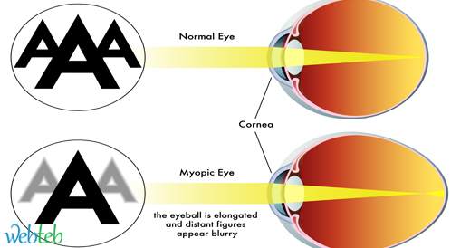 مرض جفاف العين بعد الجراحة الانكسارية Refractive surgery