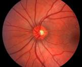 علاج جديد للعمى المرتبط بالسكري: حقن دواء بيولوجي مباشرة إلى العين