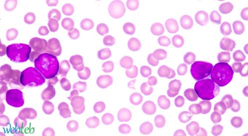 منح دواء Venetoclax وضعية دواء يتيم لعلاج سرطان الدم منح دواء Venetoclax وضعية دواء يتيم لعلاج سرطان الدم