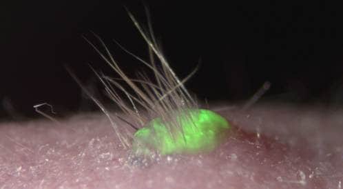تطوير خلايا جلد مخبرياً تحمل الأمل في علاج تساقط الشعر