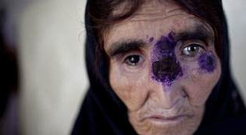 مرض جلدي ينتشر في سوريا بسبب الحرب مرض جلدي ينتشر في سوريا بسبب الحرب