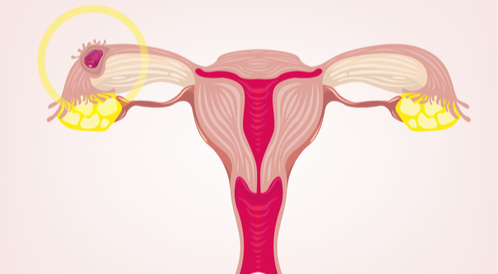 أعراض وأسباب الحمل خارج الرحم بالصور