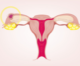 أعراض وأسباب الحمل خارج الرحم بالصور