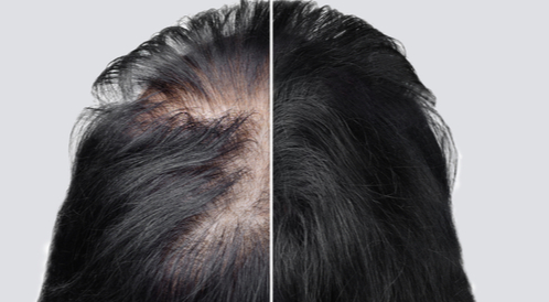 بالصور: خطوات زراعة الشعر