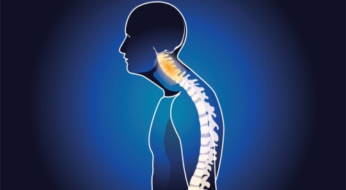 علاج تقوس الظهر بالصور