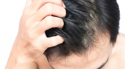 الأمراض الجلدية التي تصيب فروة الرأس بالصور
