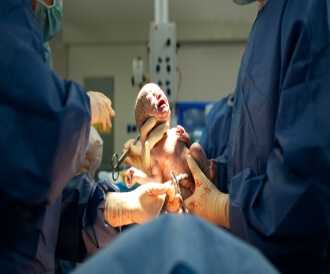 أسباب الولادة القيصرية بالصور