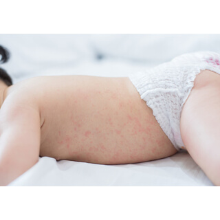 5. الطفح الجلدي (Rashes)