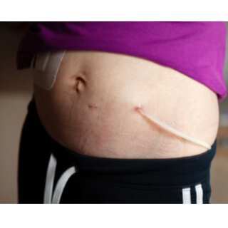 غسيل الكلى الصفاقي