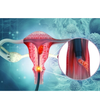 توسيع وكحت الرحم