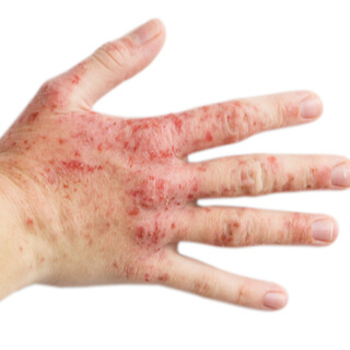 أنواع الجرب