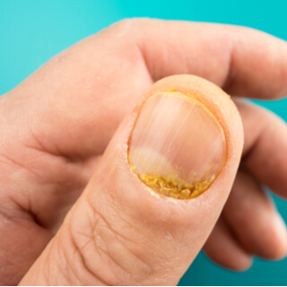 أعراض صدفية اليدين