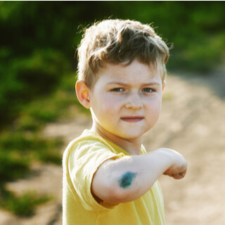 1. سهولة تكوّن الرضات