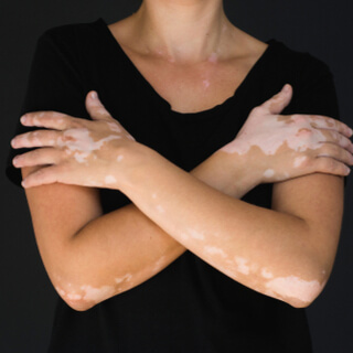 ما بعد ظهور البقع الأولية