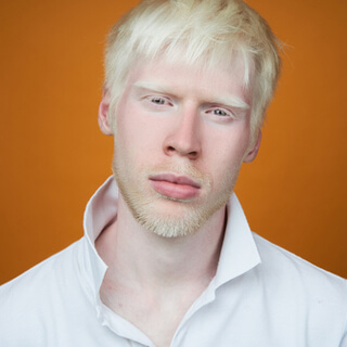 أعراض مرض البرص 