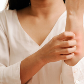 مرض الأرتيكاريا بالصور 