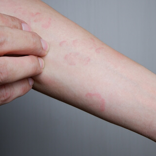 أعراض مرض الأرتيكاريا 