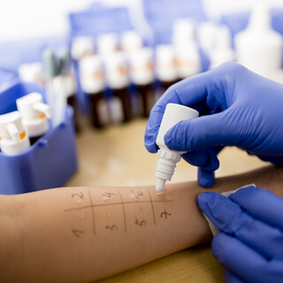 تشخيص مرض الأرتيكاريا 