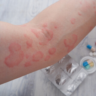 علاج مرض الأرتيكاريا  