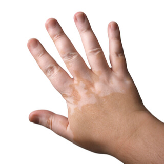 أنواع البهاق عند الأطفال