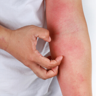 1. أعراض الذئبة الحمراء الشائعة