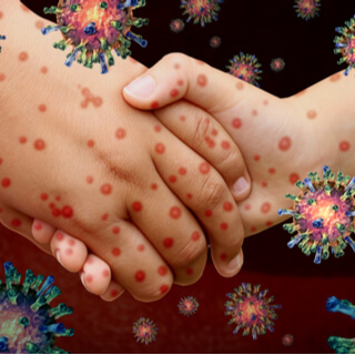 أسباب الإصابة بمرض الذئبة الحمراء