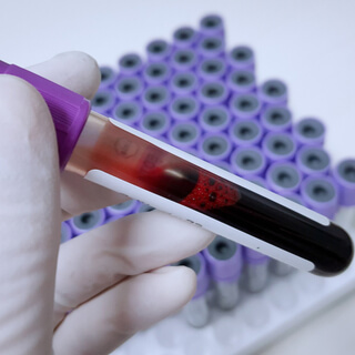 طرق تشخيص الإصابة بمرض الذئبة الحمراء