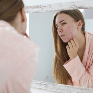 1. يساعد في علاج حب الشباب