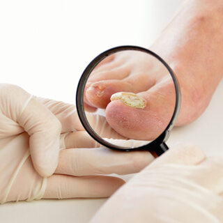 1. المساعدة في علاج الالتهابات الفطرية