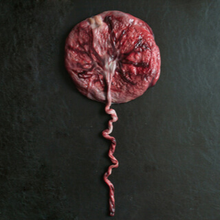 أنواع الحمل العنقودي