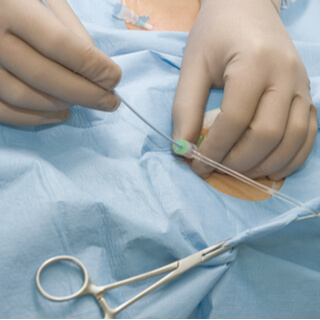 1. الخطوة الأولى من قسطرة القلب