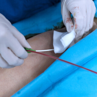 4. الخطوة الخامسة من قسطرة القلب