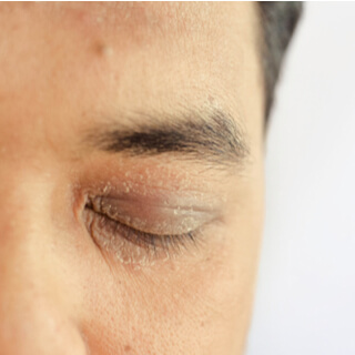 أعراض الصدفية في الجفون