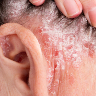 أعراض الصدفية في الأذن