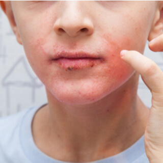 أعراض الصدفية في الفم.