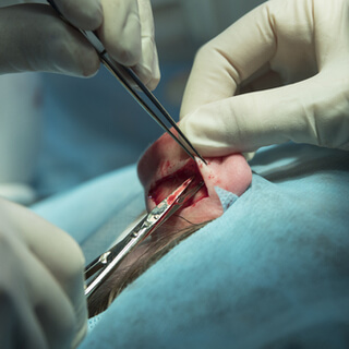 أثناء إجراء عملية تجميل الأذن