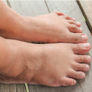 5. تورم الكاحل والقدمين