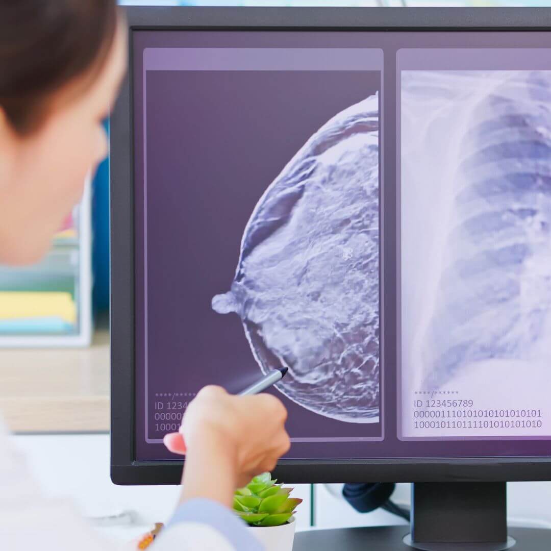 1. كتلة في الثدي 1. كتلة في الثدي