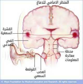 الانتقال إلى الدماغ الانتقال إلى الدماغ