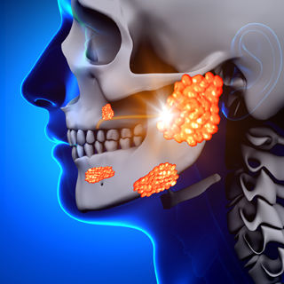 6. التهاب الغدة النكافية