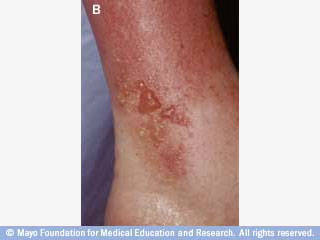 التهاب الجلد التماسي التحسسي التهاب الجلد التماسي التحسسي