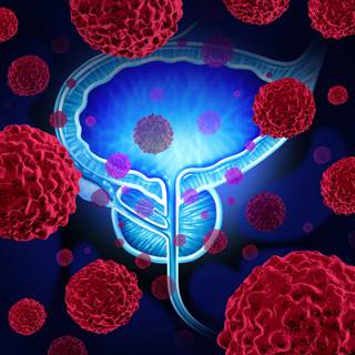  ما هي أسباب الإصابة  بسرطان البروستاتا؟