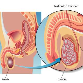 2. سرطان الخصيتين