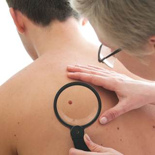 4. سرطان الجلد