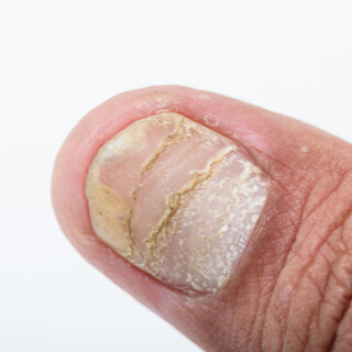 صدفية الأظافر