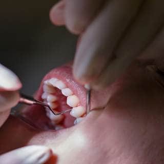 6. تراجع اللثة