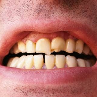 7. تصدع الأسنان